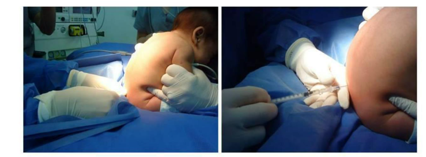 Figure 2: Position for Spinal Anesthesia.