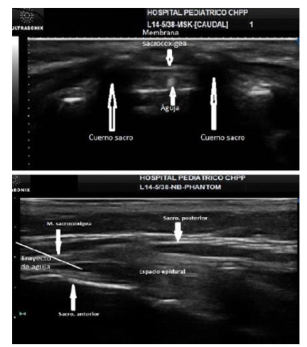 Figure 3: Ultrasound-Guided Caudal Block.