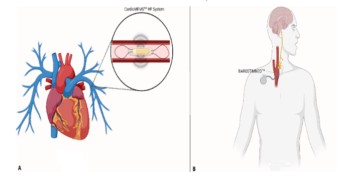 Figure 1A illustrates the CardioMEMSTM HF System, an implantable sensor placed into distal branches of the pulmonary artery during right heart catheterization. Pulmonary arterial pressures are then wirelessly transmitted to provide estimates of volume status to a reviewing clinician.