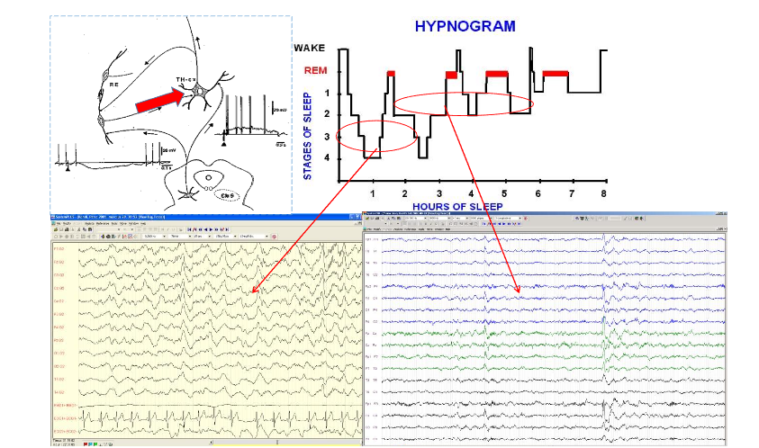Figure 2: The change of working mode of the thalamocortical network leading to NREM sleep.