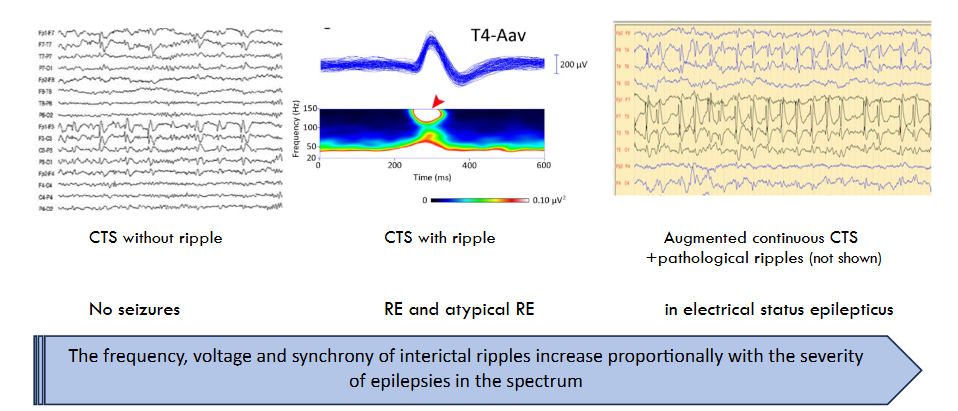 Figure 5: Three forms of centro-temporal spike (CTS) across the self-limited focal childhood epilepsy spectrum.