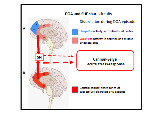 Figure 3: SHE and DOA share the same circuit. In sleep terror, there is arousal in the anterior cingulate gyrus; overlapping with the seizure-onset zones of successfully operated SHE patients.