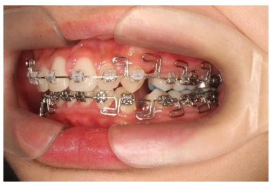 The MEAW set during the closing extraction space.