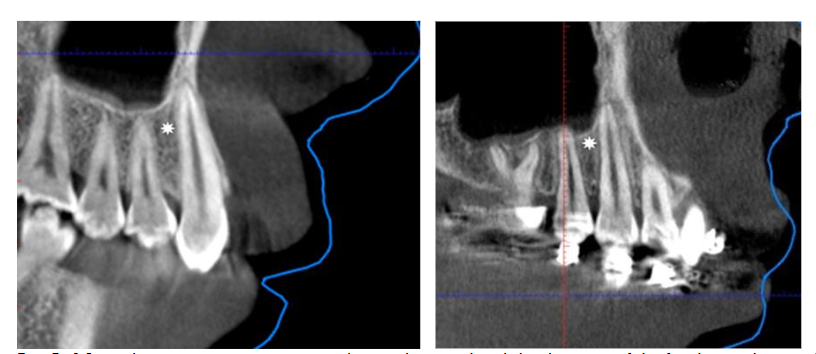 Bone density measurements were taken on the mesial and distal aspects of the first bicuspids, at a distance of one-third from the apex.
