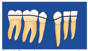 The arch shows a bowing effect after bicuspid extraction.