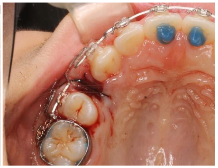 The extracted first bicuspid root shows only the width of the cervical area.