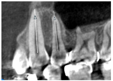Checking for the roots paralleling.