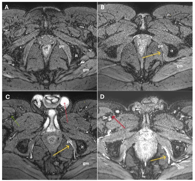 Figure 1. Grading of pudendal nerve signal brightness on axial oblique BB images, using stationary fluid (thin red arrow) and flow suppression (thick red arrow) as references. Upper panel (a b): Grade 0, no hyperintensity; Grade 1, minimal increase. Lower panel (c d): Grade 2, clear increase not equal to fluid; Grade 3, marked increase with nerve enlargement. Abbreviations: pn, pudendal nerve; it, ischiatic tuberosity; gm, gluteus maximus.