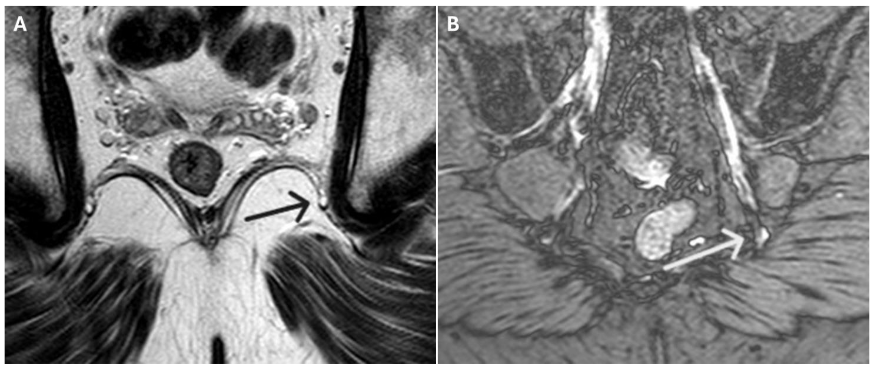 Figure 2. Grade 2 pudendal neuropathy at the nerve's entry into Alcock's canal. MR neurography, coronal oblique view: Side-by-side comparison of TSE T2-weighted image (a) and double IR BB sequence (b) shows clear identification of the pudendal nerve in end-on view (arrows), with hyperintense signal just below the ischial spine, unobscured by overlapping structures.