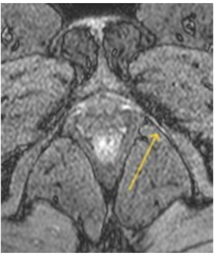 Figure 3. Example of Grade 1 pudendal neuropathy (yellow arrow), initially misclassified as Grade 0. Axial oblique PD_SPAIR double IR BB MR neurography reveals subtle increase in pudendal nerve signal intensity.
