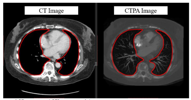 Figure 2. Comparison of CT images and CTPA images of the same cross-section.