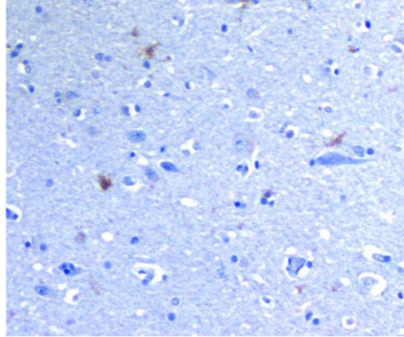 Figure 1. TLR 2 in hippocampal brain section stained with CD 282 immunostain (stains black); with the MyD88 pathway, it creates many of the cytokines noted in AD brains. NFT are noted as “tear drop” structures.