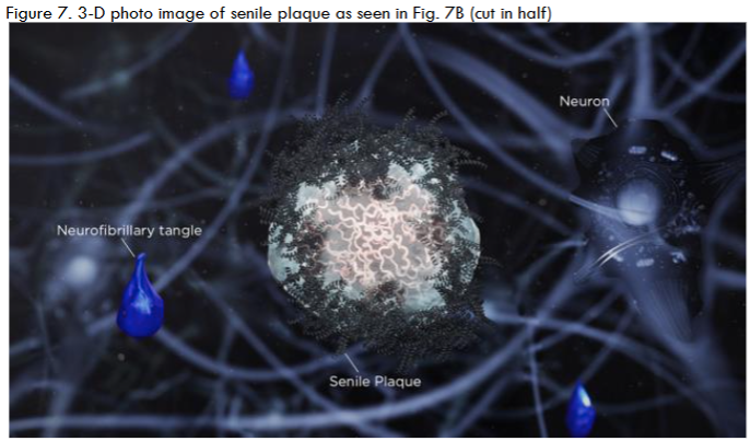 Figure 7. 3-D photo image of senile plaque as seen in Fig. 7B (cut in half).