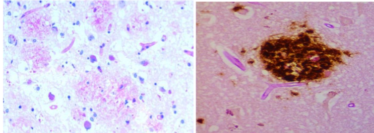 Figure 6A. Senile plaques stained with Periodic Schiff (PAS) for demonstration of biofilms.