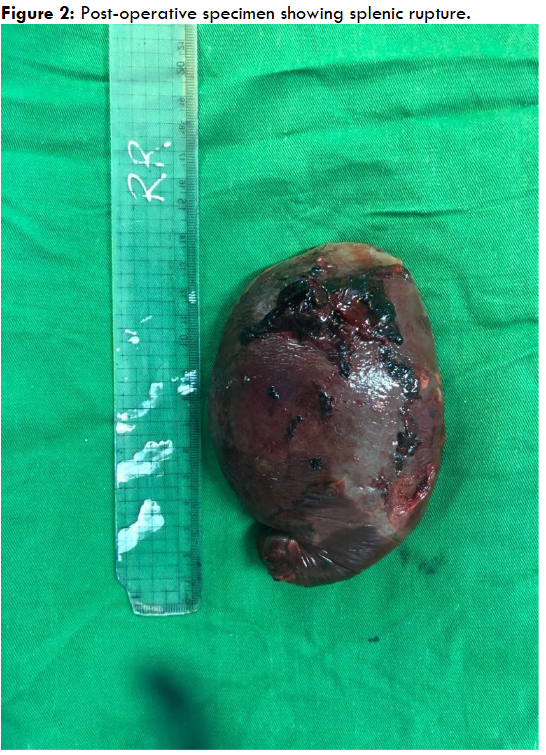 The post-splenectomy specimen shows an enlarged spleen with areas of subcapsular hemorrhage and discoloration, suggestive of traumatic or pathological involvement.