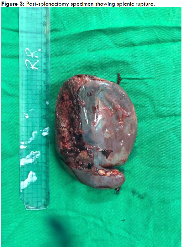 The excised spleen demonstrates gross features consistent with splenomegaly and traumatic rupture, likely secondary to malarial infection. This correlates with the clinical picture of acute abdomen and hemorrhagic shock in a patient with confirmed Plasmodium parasitemia. Laboratory findings of anemia, thrombocytopenia, and parasitemia support the diagnosis.