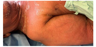 Figure 3. Improvement of erythema after initiation of antibiotic therapy, with persistence of marked desquamation, observed on the fifth day of hospitalization.