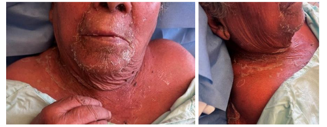 Figure 1 A-C. Diffuse exanthem with superficial desquamation, observed on the first day of hospitalization, involving the perioral, periorbital, and cervical regions; a positive Nikolsky sign is present on the neck.