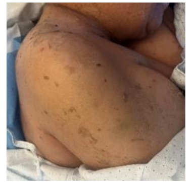 Figure 4. Near-complete resolution of the erythematous and desquamative findings on the tenth day of hospitalization, with intact skin.