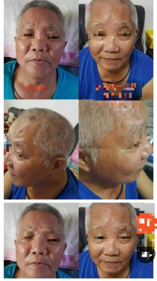 Picture 7. Before consuming stem cells (left)