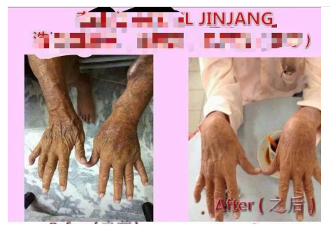 Picture 6. After consuming stem cells for one month (right)