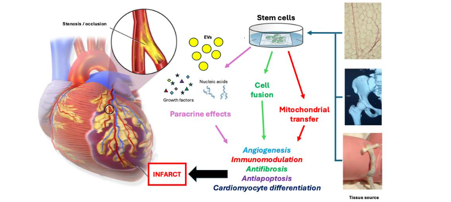 Figure 1. Stem cell mechanisms for cardiac regeneration. Stem cells harvested from different tissues such as adipose, bone marrow, and umbilical cord are cultured and delivered intravenously after acute myocardial ischemia or infarction. Regeneration of damaged myocardium occurs mainly from paracrine effects of the stem cell secretome, which include extracellular vesicles (EVs), nucleic acids, peptides and cytokine proteins that act as growth factors. Direct interaction of stem cells within the ischemic or infarcted area includes cell fusion and mitochondrial transfer through gap junctions. Beneficial effects of stem cell therapy include recruitment of intrinsic cardiac stem cells and promotion of cardiomyocyte differentiation, repression of fibrosis and apoptosis, angiogenesis, and immunomodulation. (Adapted from Blausen Medical Communications, Wikimedia Commons)