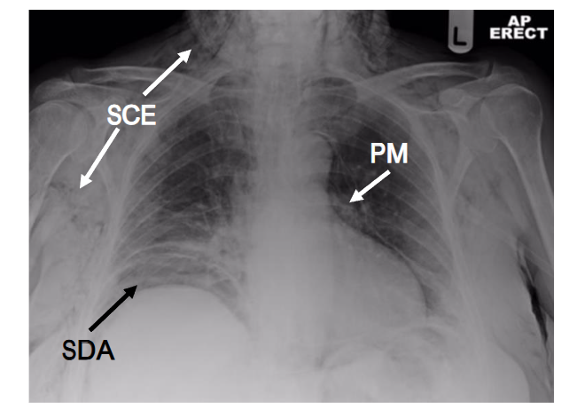 Figure 1. Chest radiograph demonstrating subcutaneous emphysema (SCE), pneumomediastinum (PM) and subdiaphragmatic air (SDA).