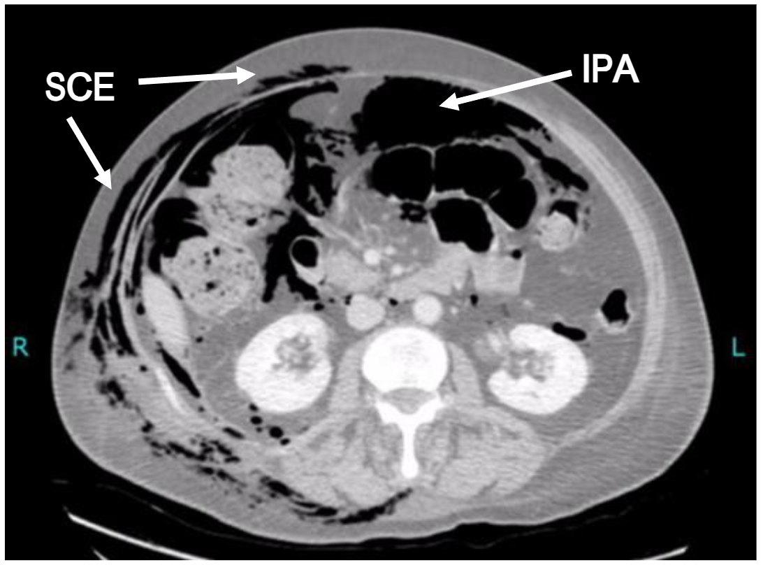 Figure 2. Saggital computed tomography (CT) image showing subcutaneous emphysema (SCE) and intra-peritoneal air (IPA) secondary to colonic perforation.