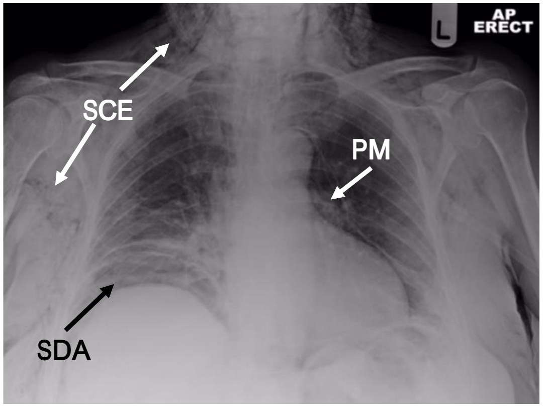Figure 1. Chest radiograph demonstrating subcutaneous emphysema (SCE), pneumomediastinum (PM) and subdiaphragmatic air (SDA).