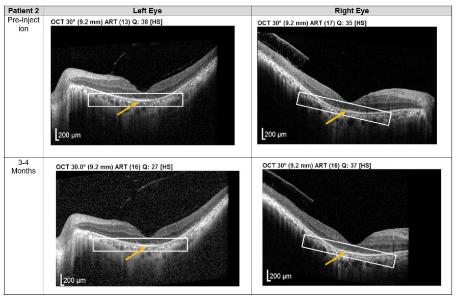 Figure 2. Optical coherence tomography (OCT) images for both eyes of Patient 2 from pre-injection up to 11 month follow-up. Orange arrow demonstrates the presence of hyperreflective material at the interdigitation area of the photoreceptors at the macula and extramacular region. These were observed and maintained until the last follow-up examination.