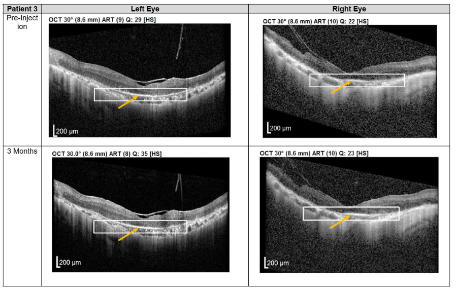 Figure 3. Optical coherence tomography (OCT) images for both eyes of Patient 3 from pre-injection up to 1 year follow-up. Orange arrow demonstrates the presence of hyperreflective material at the interdigitation area of the photoreceptors at the macula and extramacular region. These were observed and maintained until the last follow-up examination.
