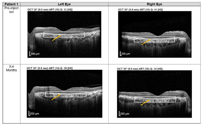 Figure 1. Optical coherence tomography (OCT) images for both eyes of Patient 1 from pre-injection up to 1 year follow-up. Orange arrow demonstrates the presence of hyperreflective material at the interdigitation area of the photoreceptors at the macula and extramacular region. These were observed and maintained until the last follow-up examination.