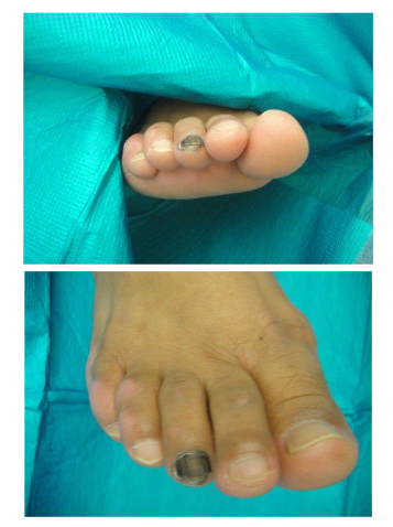 Table 1. The alphabet of nail melanoma: Steps to keep in mind when examining nails for the presence of subungual melanoma.