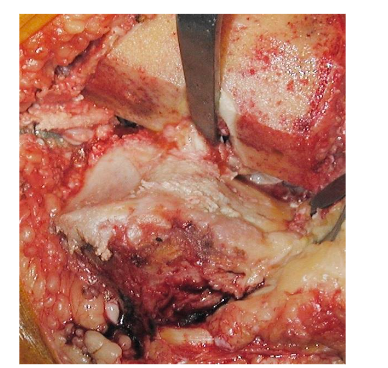 Drilling of the defect area using the patella drill. Source: Author's personal archive