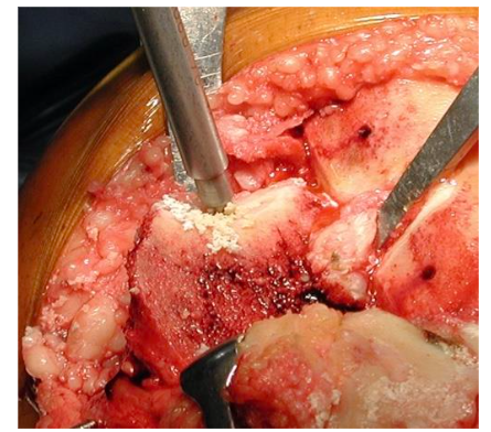 Final aspect of the defect bed. Perforations represent the angulation of the tibial wall. Source: Author's personal archive