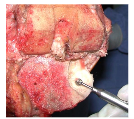 Bone fragment resulting from the cut of the posterior stabilization box. Source: Author's personal archive