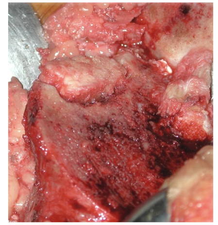 Impacted graft in the lateral femoral condyle. Source: Author's personal archive