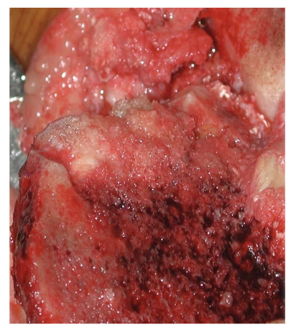 Graft flush with the cut surfaces. Source: Author's personal archive