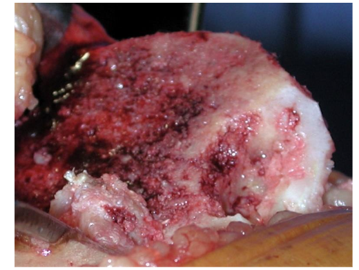 Graft positioned, supported on the defect bed and extending above the bone surface level. Source: Author's personal archive