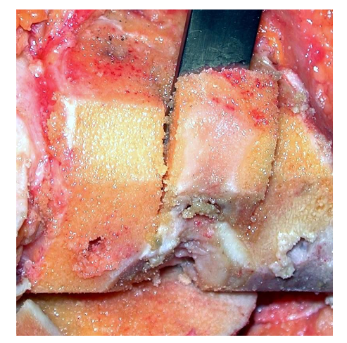 Placement of the shaped graft on the lateral femoral condyle in revision arthroplasty. Source: Author's personal archive