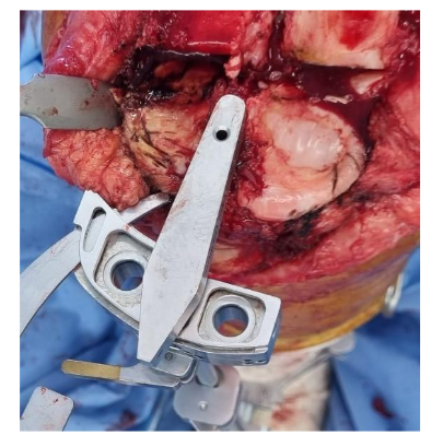 Unpositioning of the tibial cutting guide corresponding to the smallest polyethylene thickness of the system used, based on the least compromised plateau. Source: Author's personal archive
