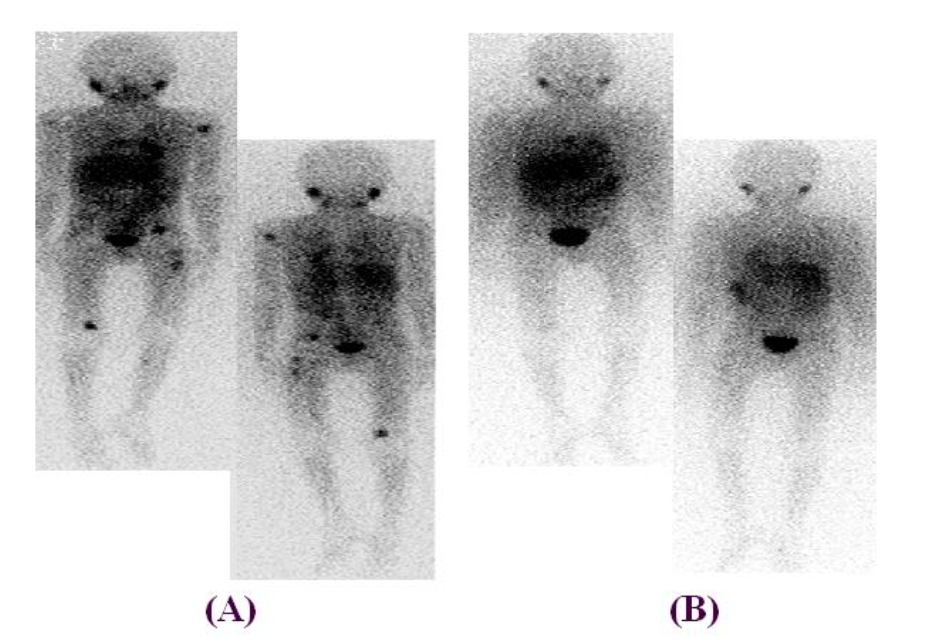 Figure 3: The phenomenon of "false complete response" following 131-I-mIBG therapy, as detailed by Rubio et al. (2020), highlights the challenges in accurately assessing treatment outcomes in neuroblastoma.