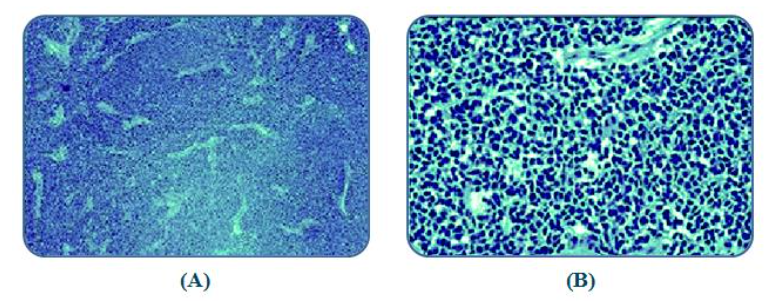 Figure 2: (A-B) Histopathological images from the patient (Alexander et al., 2021). The images highlight neuroblastic differentiation and mitosis karyorrhexis index variations, key to prognosis and classification in neuroblastoma pathology.