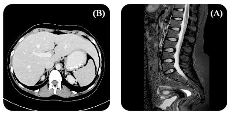 Figure 1: MRI scan images (A, B) of a patient with abdominal neuroblastoma, demonstrating distinct tumour characteristics. Image A highlights the tumour's irregular shape and size, while Image B emphasizes the extent of invasion into surrounding tissues.