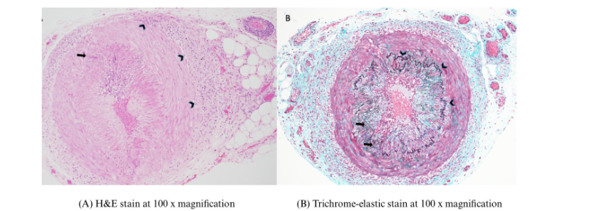 Giant cell arteritis, right temporal artery (A). H&E stain at 100 x magnification. There is transmural granulomatous inflammation fragmenting the internal elastic lamina (arrow) and milder disruption of the external elastic lamina (chevrons). (B) Trichrome-elastic stain at 100 x magnification. There is partial destruction of the internal elastic lamina (arrows) with foci of residual intact areas (chevrons). It is pathognomonic to see patchy destruction of the elastic laminae.