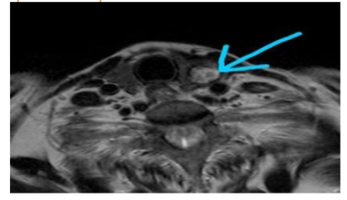 Well-defined solid nodule in the left lobe of the thyroid.