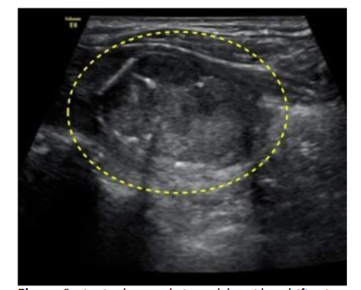 An iso-hyperechoic nodule with calcification (2.8 x1.9cm) in the left lobe of the thyroid.