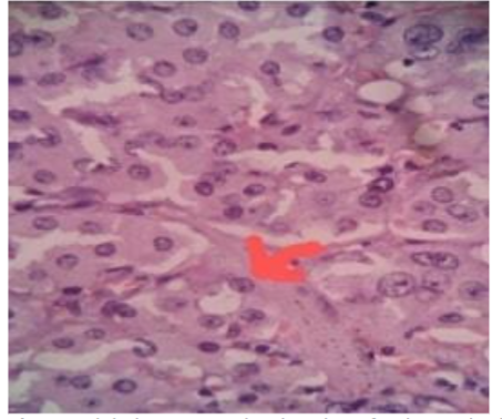 Lobules, nest, and trabeculae of polygonal cells, vesicular nuclei, distinct nucleoli, stippled chromatin, and abundant cytoplasm with areas of necrosis. (high power field).