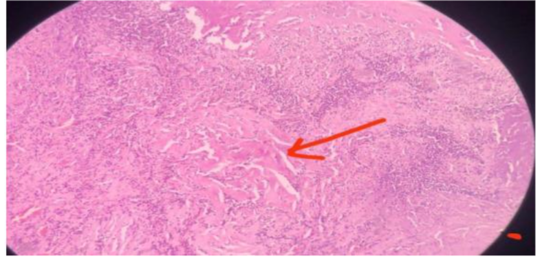 Lobules, nest, and trabeculae of polygonal cells, vesicular nuclei, distinct nucleoli, stippled chromatin, and abundant cytoplasm with areas of necrosis. (low power field).