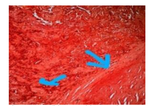 Extracellular eosinophilic material suggestive of amyloid seen.